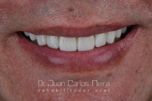 Dr. juan Carlos Neira Smile Design with Ceramic Lenses in Upper Jaw (Minimally invasive Dentistry).