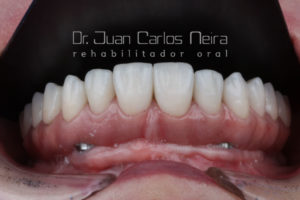 Dr. Juan Carlos Neira Hybrid Prosthesis in Cobalt-Chromium CAD-CAM (Phibo) and Ceramic with Single Lithium Disilicate Crowns